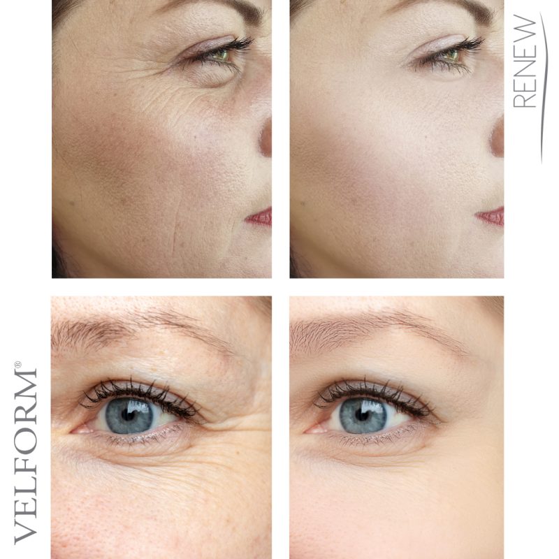 Tratamento facial anti-idade com colagénio e ácido hialurónico