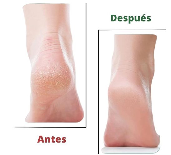 Removedor de calos